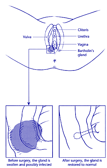 bartholin gland cyst. of a Bartholin#39;s cyst or